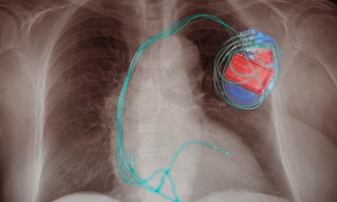 x-ray image showing electronic device within a person's chest