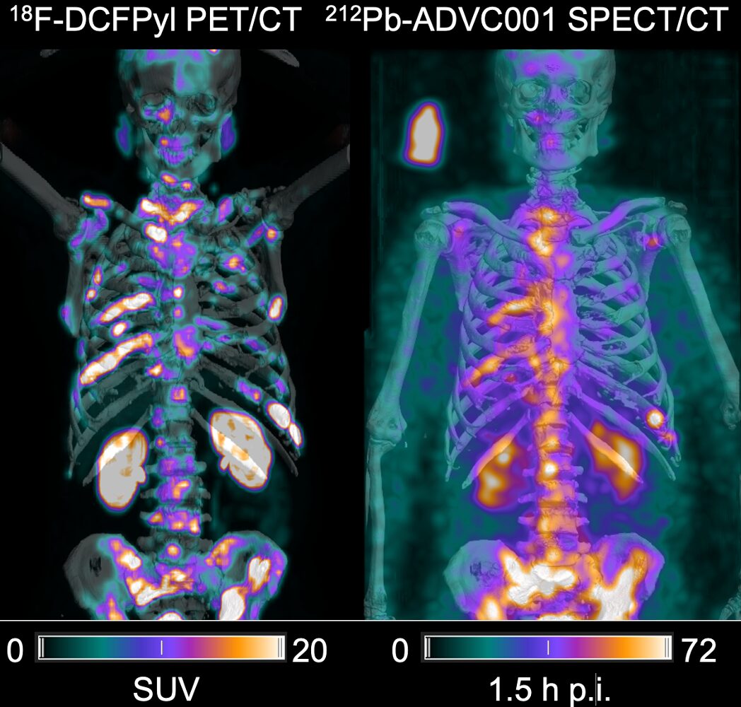 Case Study_NIF_First in-human images of new hope treatment for poor-prognosis prostate cancer